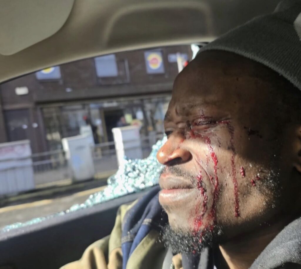 Nigerian dancer risks permanent blindness after brutal road-rage in Ireland
